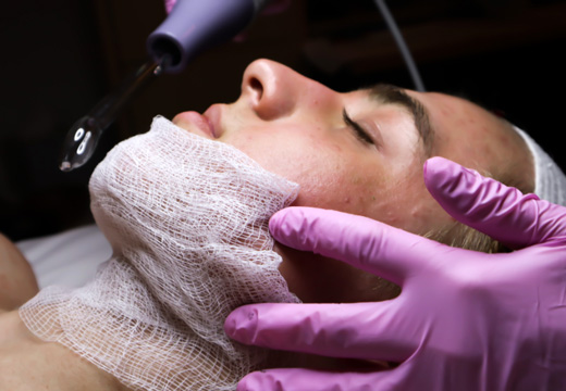 RADIOFRECUENCIA FACIAL