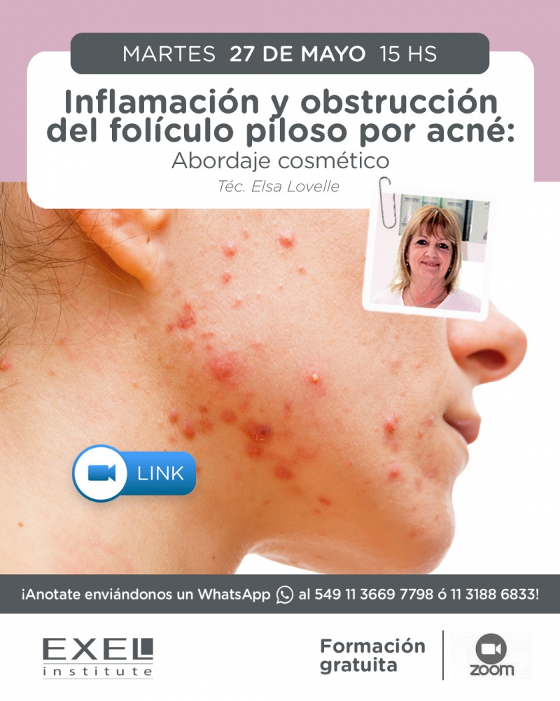 Zoom > Inflamacin y obstruccin del folculo piloso por acn